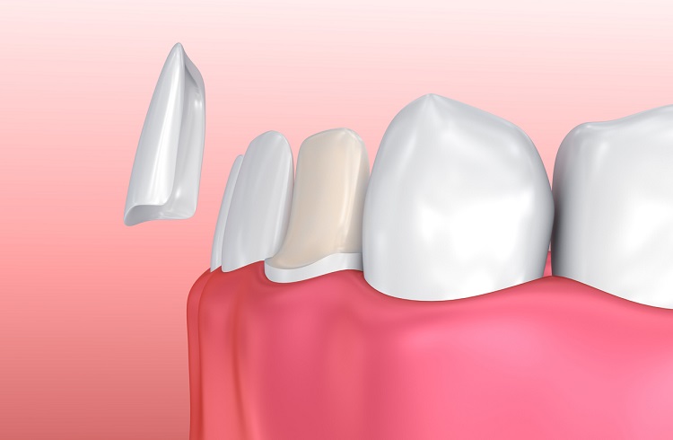 Cara merawat veneer gigi yang tepat, Sumber: artofmoderndentistry.com