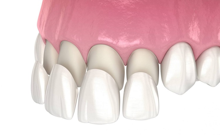 Perawatan veneer gigi, Sumber: dentistsco.com