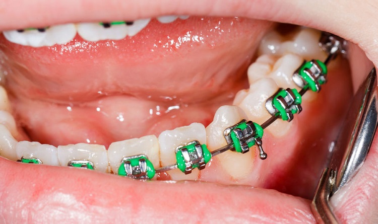 Melakukan kontrol behel gigi rutin ke dokter gigi, Sumber: klikdokter.com