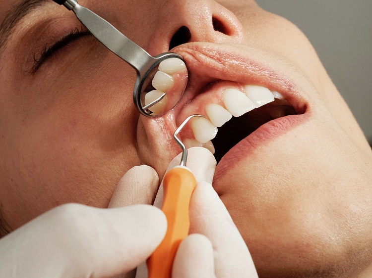 Pembuatan gigi gingsul buatan wajib dilakukan dokter gigi yang kompeten, Sumber: markham7dental.com