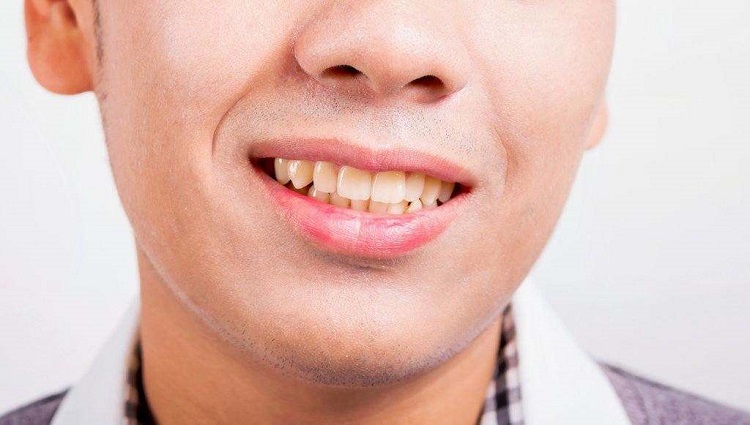 Mengenal penyebab gigi kuning padahal rajin sikat gigi, Sumber: doktersehat.com