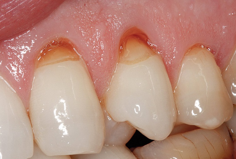 Abrasi gigi yang membuat tampilan kurang menarik, Sumber: dentagama.com