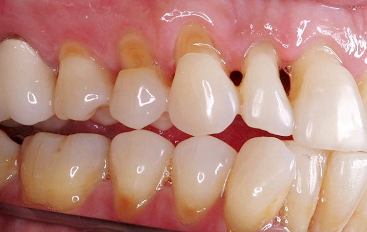 Mengkonsultasikan kepada dokter jika abrasi gigi sudah sangat parah, Sumber: klinikrespirasimalang.com