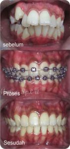 gigi maju setelah perawatan behel