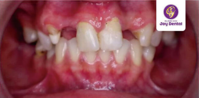contoh gejala erosi gigi