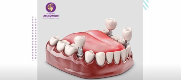 Implan Gigi di Klinik Gigi Joy Dental