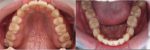 Lengkung gigi akhir setelah perawatan behel