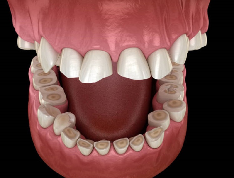 Mengenal penyebab atrisi gigi, Sumber: istockphoto.com