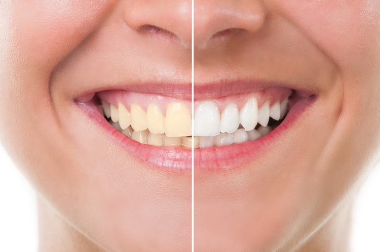 Perbedaan gigi sebelum dan sesudah bleaching, Sumber: stjohnhealth.com.au