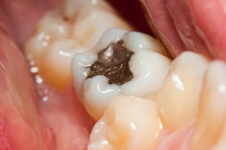 Bentuk tambalan gigi, Sumber: alodokter.com