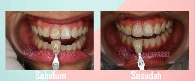Gigi hitam sebelum dan sesudah perawatan
