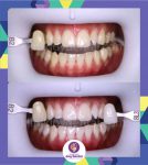 Perawatan Bleaching Gigi di Joy Dental