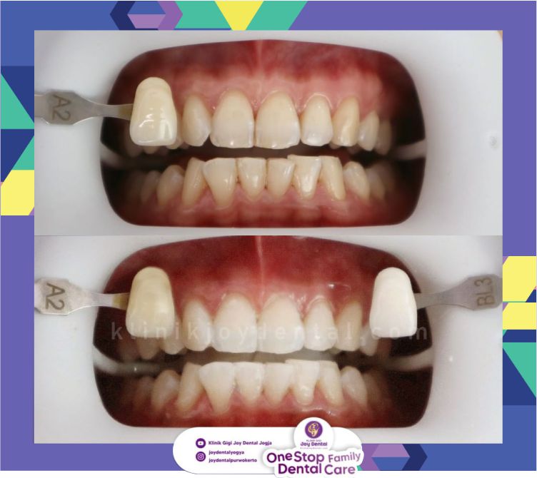Perawatan Dental SPA di Klinik Gigi Joy Dental