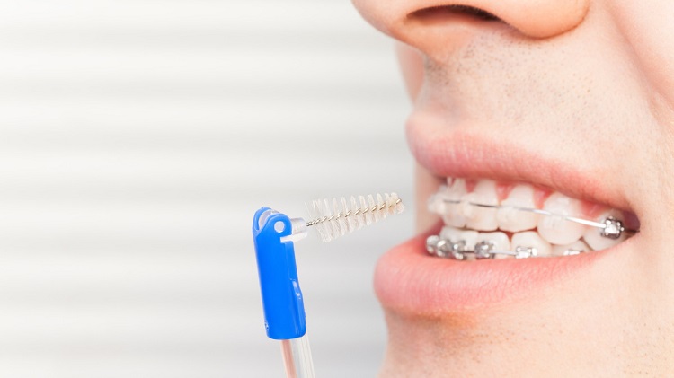 Perawatan untuk behel gigi, Sumber: klikdokter.com