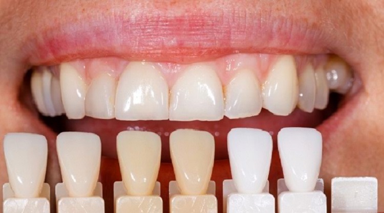 Mengembalikan warna gigi dengan prosedur veneer, Sumber: alodokter.com
