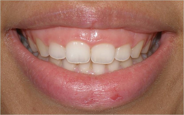 Cara mengatasi gummy smile, Sumber: waraswiris.com