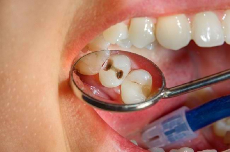 Gigi berlubang menjadi salah satu faktor perubahan warna gigi, Sumber: alodokter.com