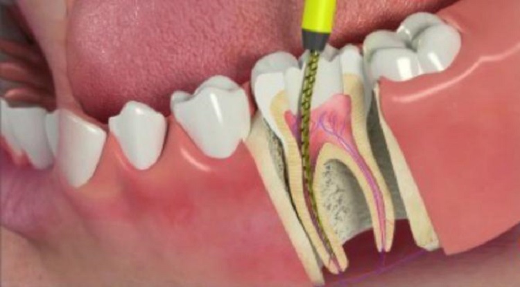 Melakukan perawatan saluran akar gigi, Sumber: liputan6.com
