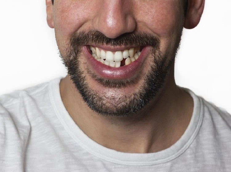 Mengatasi gigi ompong di usia muda, Sumber: health.detik.com