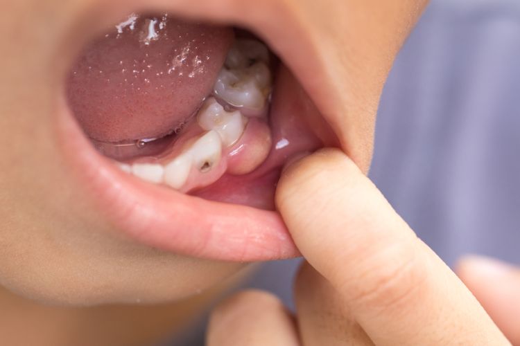 Mengenal apa itu abses gigi, Sumber: health.kompas.com