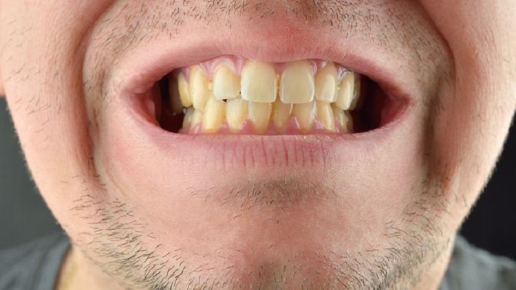 Penyebab gigi berwarna coklat, Sumber: klikdokter.com