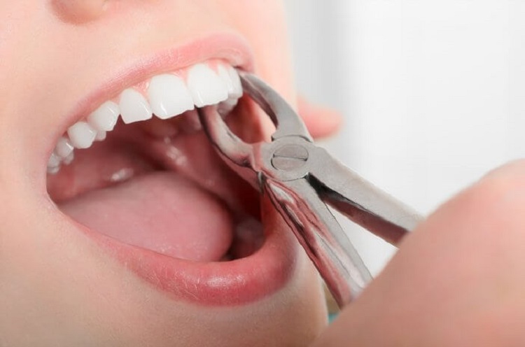 Prosedur pencabutan gigi, Sumber: halodoc.com
