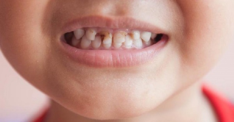 Mengenal penyebab karies gigi pada anak, Sumber: popmama.com