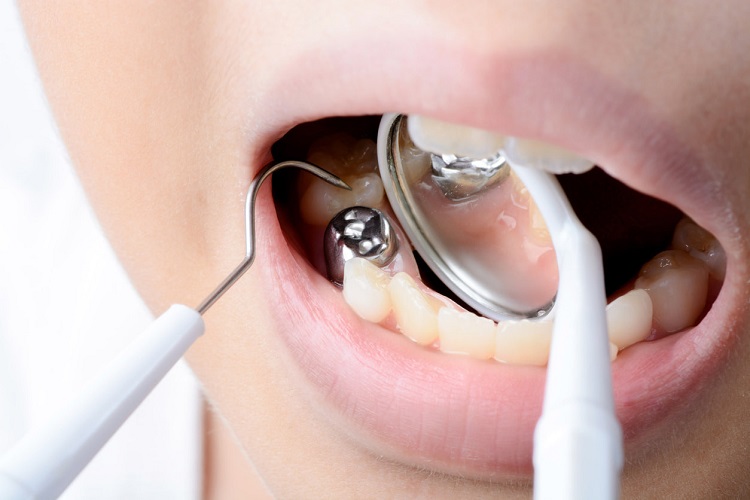 Tambalan gigi rusak bisa menyebabkan gusi berdarah, Sumber: honestdocs.id