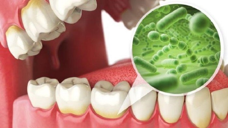 Aktivitas bakteri pada gigi, Sumber: health.tribunnews.com