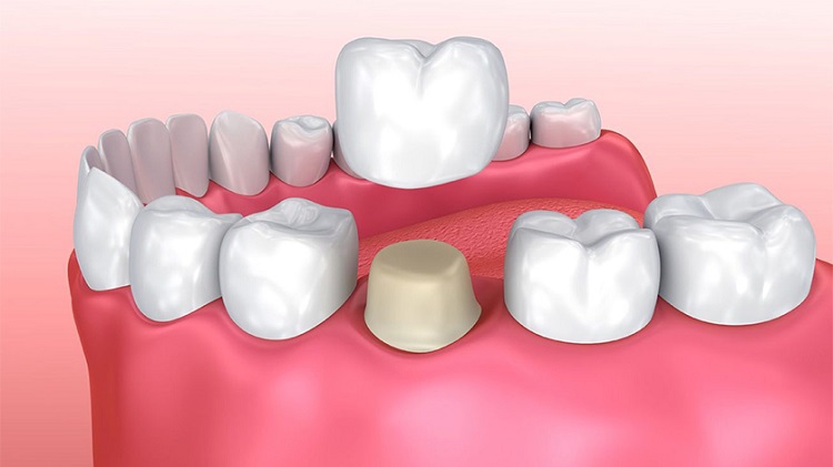 Ilustrasi pemasangan mahkota gigi, Sumber: theclinicindonesia.com