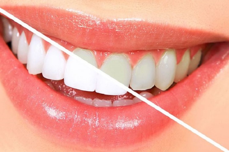 Memutihkan gigi dengan teknik bleaching, Sumber: grid.id