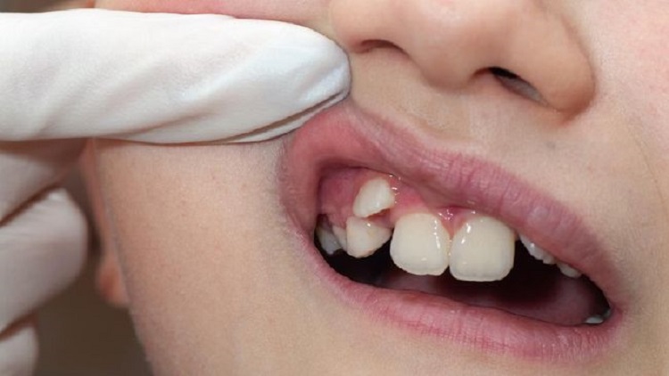 Mengenal solusi mengatasi gigi tidak rapi, Sumber: cnnindonesia.com