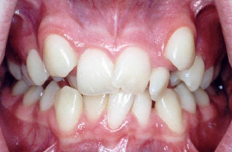 Kondisi gigi yang tidak beraturan, Sumber: drnaqiuddin.blogspot.com