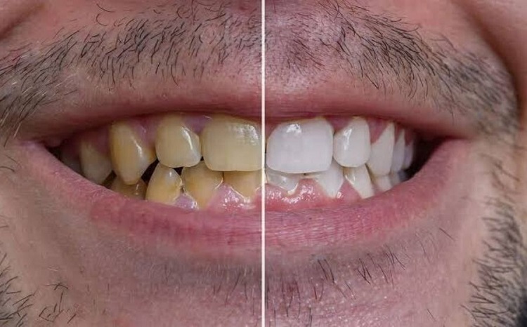 Perubahan warna pada gigi, Sumber: kompasmu.github.io