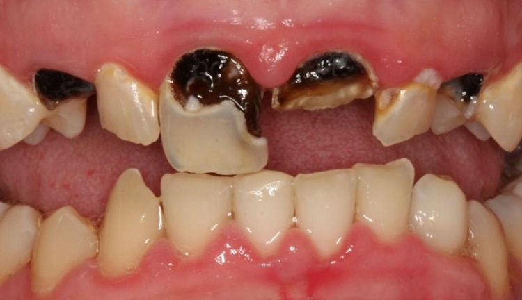 Ilustrasi gigi yang keropos, Sumber: twitter.com