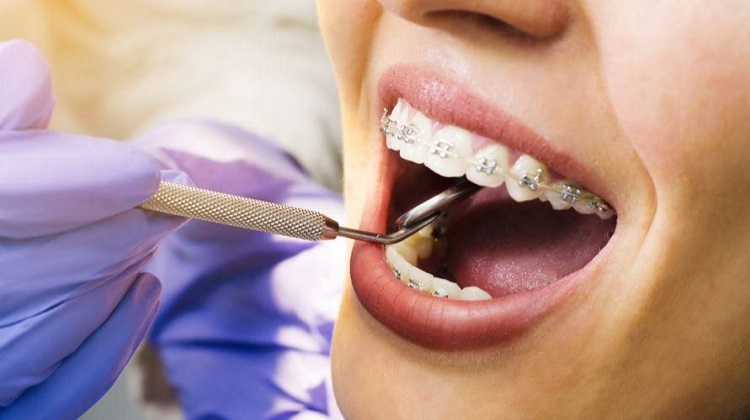 Melakukan kontrol rutin ke dokter gigi terkait penggunaan behel, Sumber: sehatq.com