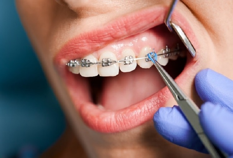 Melakukan perawatan ortodontik, Sumber: alomedika.com