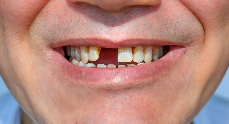 Mengenal penyebab kenapa gigi tidak tumbuh, Sumber: gelarsramdhani.com