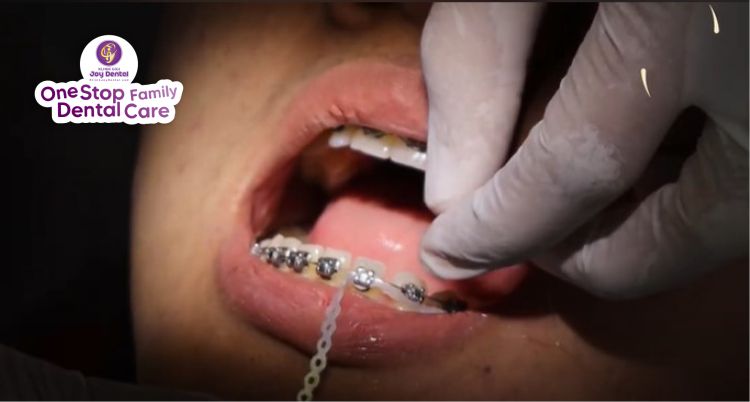 Kontrol behel gigi di Joy Dental