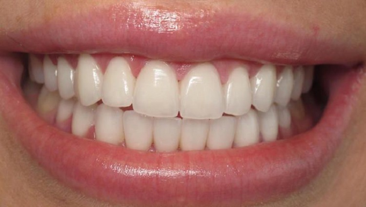 Informasi terkait cara merapikan gigi tanpa behel, Sumber: Pinterest