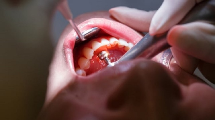 Pemeriksaan gigi di dokter gigi, Sumber: kumparan.com