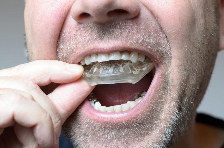 Penggunaan pelindung gigi, Sumber: stonebridgedental.com