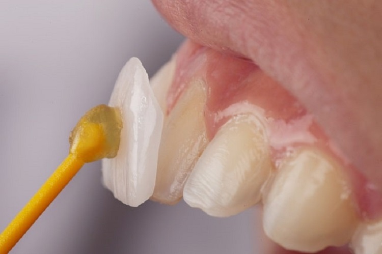 Perawatan veneer gigi, Sumber: alomedika.com