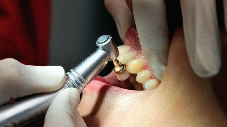 Potong gigi dalam dunia kedokteran gigi, Sumber: cnnindonesia.com