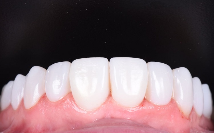 Tindakan dental contouring, Sumber: mouth.co.uk