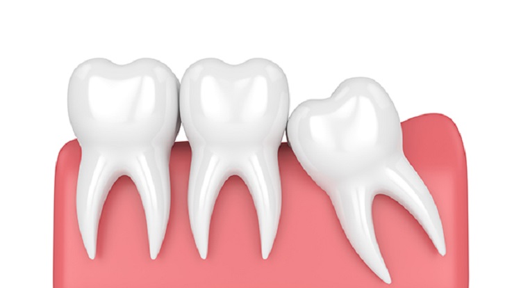 Contoh gigi bungsu yang tumbuh tidak normal, Sumber: halodoc.com