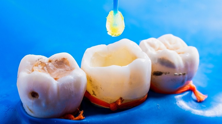 Mengatasi tambalan gigi yang lepas, Sumber: klikdokter.com
