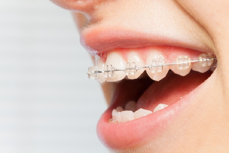 Perawatan behel untuk merapikan gigi, Sumber: hdmall.id