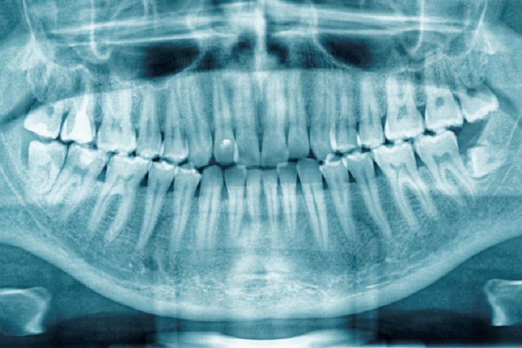 Mengenal apa itu rontgen gigi periapikal, Sumber: hdmall.id