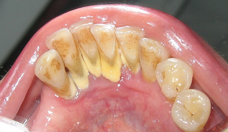 Karang gigi yang tidak dibersihkan bisa menimbulkan berbagai masalah, Sumber: id.wikipedia.org